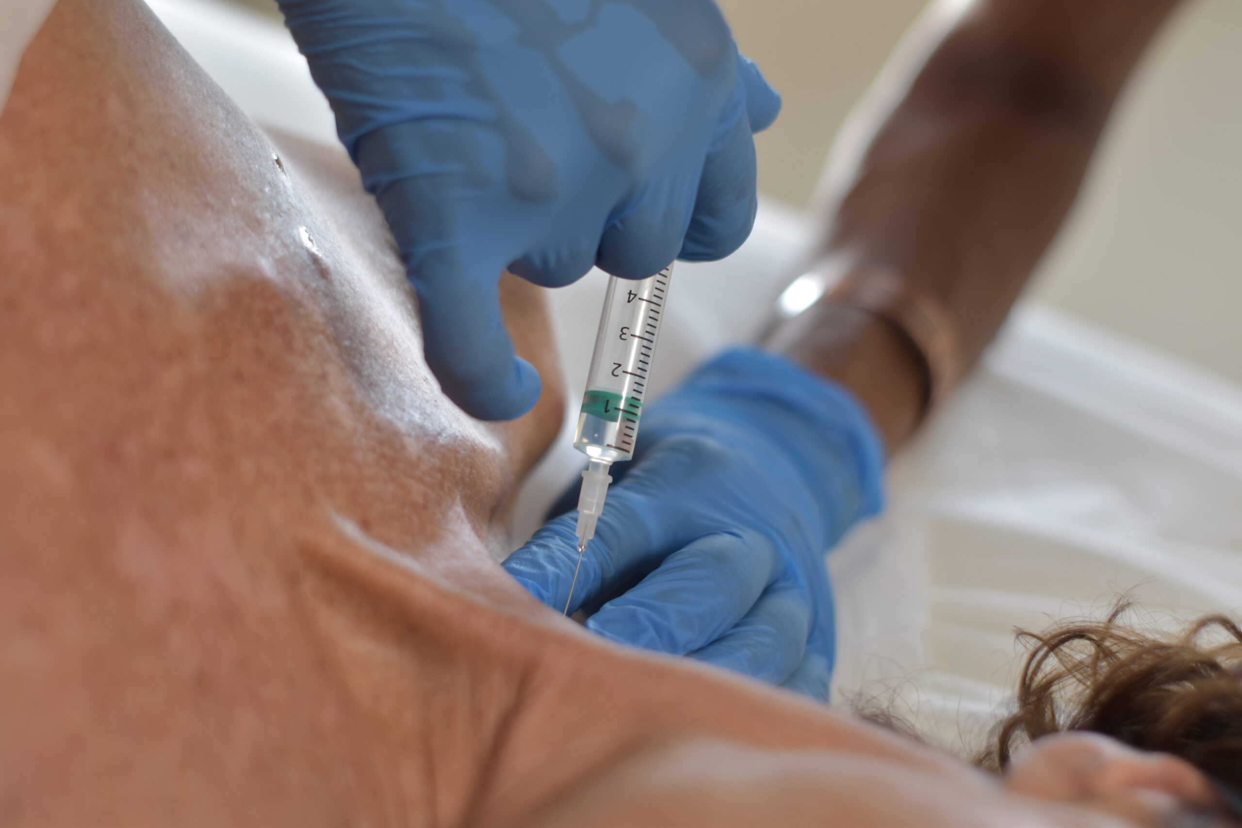 clienta recibiendo un tratamiento de acido hialuronico