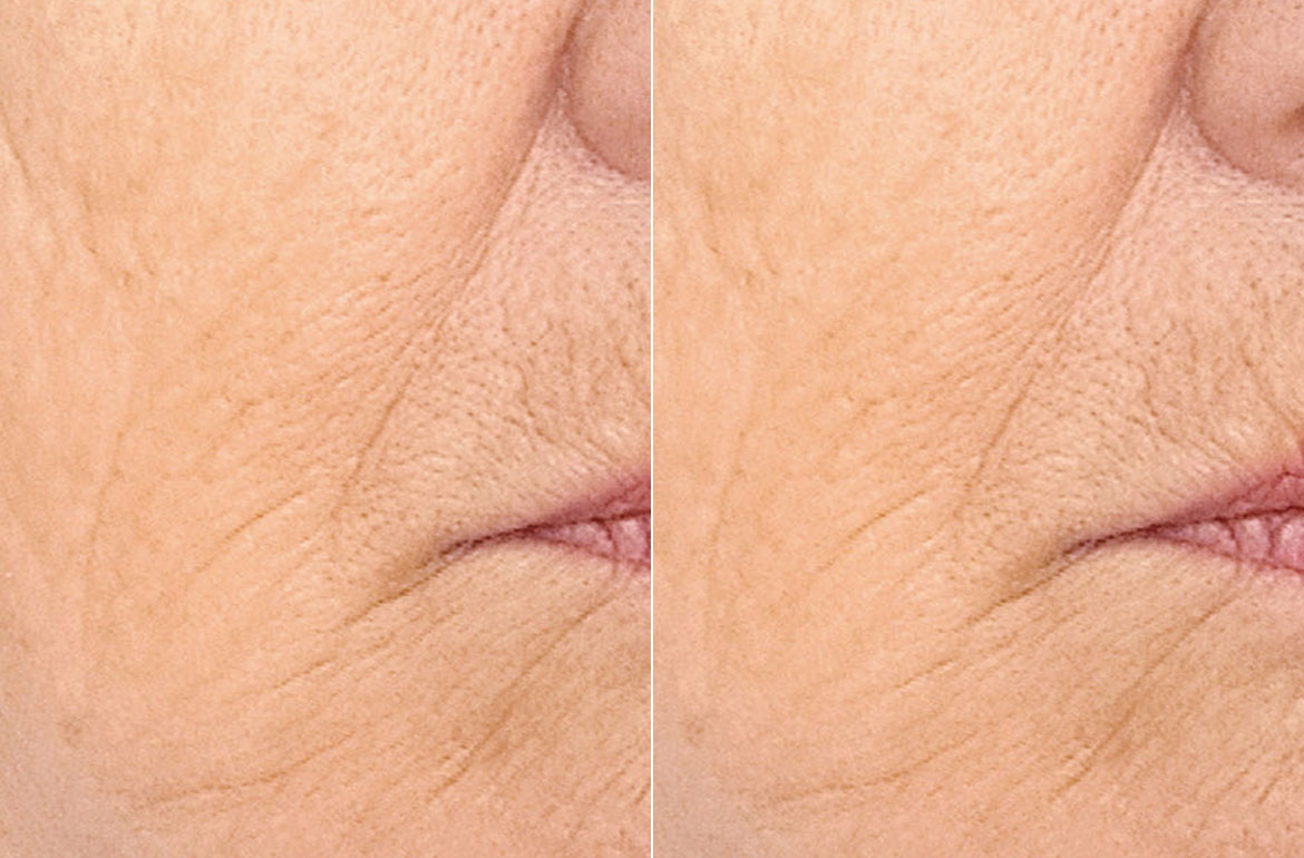 antes y después de cara de mujer con y sin rellenos 2
