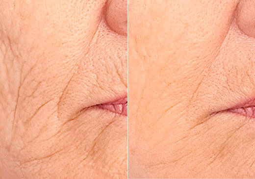 antes y después de cara de mujer con y sin rellenos